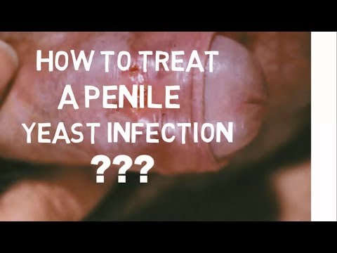 Authoritative point Candidiasis penis Candidiasis penis excellent question